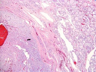 Case Report: Metastatic renal cell carcinoma to the thyroid— A rare encounter